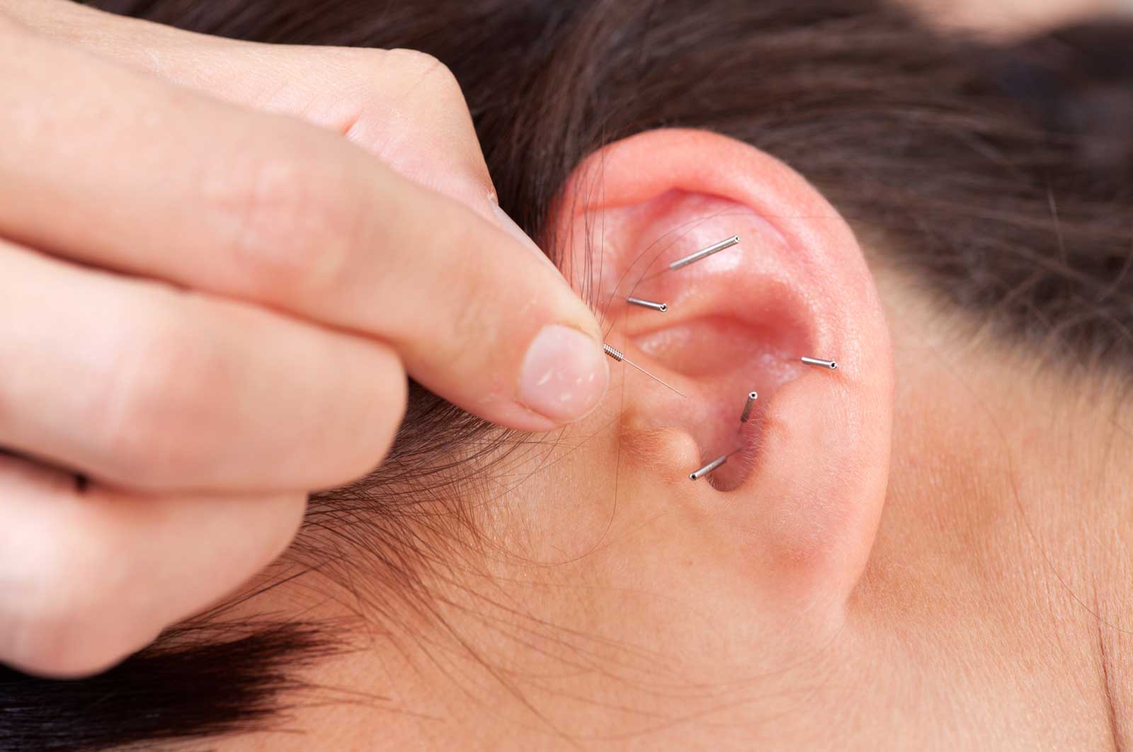What are the benefits of Auricular Acupuncture?